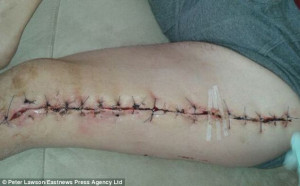 ... horrific wound inflicted by poisonous spider that is plaguing Britain