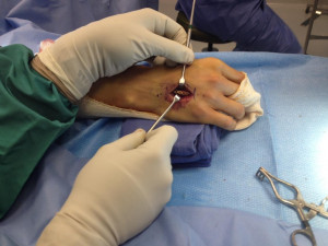 LAST WARNING: OPEN HAND SURGERY PIC IS NEXT. SKIP IT IF YOU'RE ...