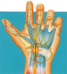 Carpal Tunnel Syndrome?