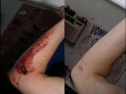 Fresh road rash and its resultant scarring one year later.