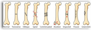 Broken bones/ x-rays