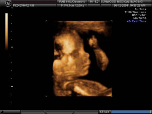 Picture Trimester Ultrasound