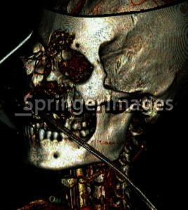 ... (focal facial smash) from explosion in close proximity to the blast