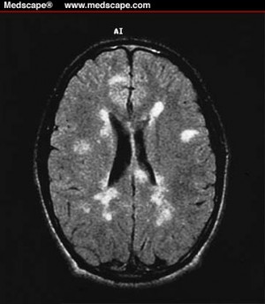 MS lesions (Multiple Sclerosis) MRI Brain Scan by britta.hansen.900