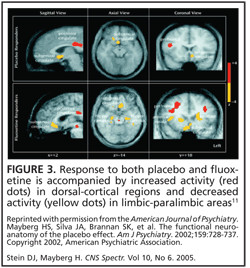 placebo. You can present colorful brain images that show real placebo ...