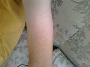Scars From Cutting Of cutting. the scars that