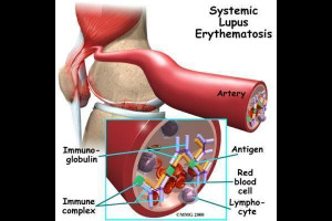 systemic lupus erythematosus