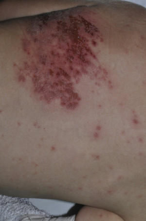 Related to What Is Disseminated Herpes Zoster With Pictures