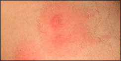 Bed Bug Bites Picture The
