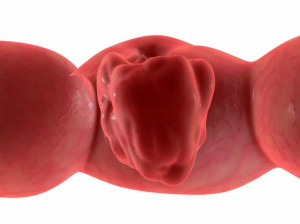 ... the number of deaths from bowel cancer by more than 25 per cent