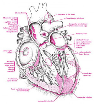 Types of Cardiovascular Disease | Cardiovascular Disease and Healthy ...