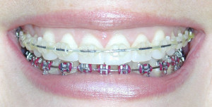 Orlando Braces