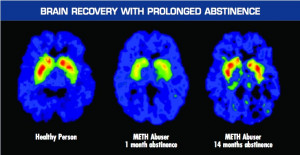 Alcohol Addiction Brain Treat addiction as a brain