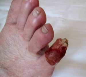 Little Blister On Toe