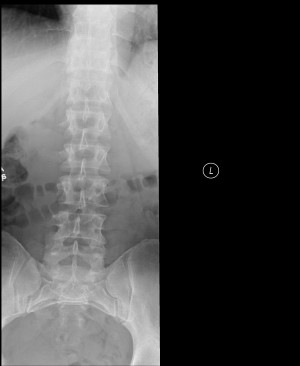 Spina Bifida Occulta X ray