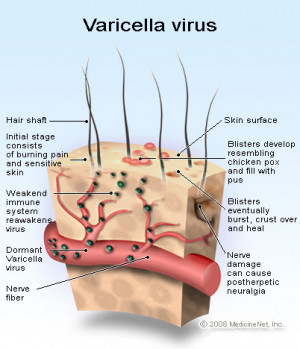 ... the varicella zoster virus causes shingles and postherpetic neuralgia