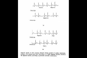 Cardiac arrhythmia Picture Slideshow