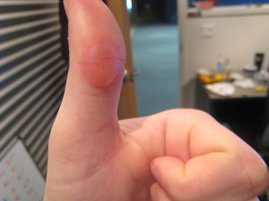 small blisters on fingers