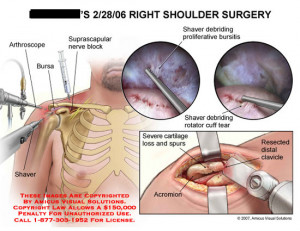 An Open Distal Clavicle Resection Acromioplasty And Bursectomy