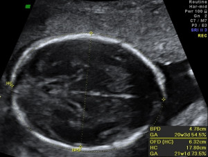 Ultrasound Fetal Head Circumference