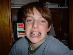 Before Getting Braces off Image