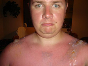 Sunburn in Florida....not so much fun