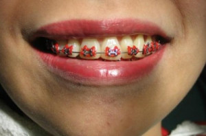 27 thoughts on “ Hello Kitty Braces ”