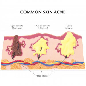 Acne Skin Model