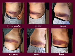 Bruise Timeline