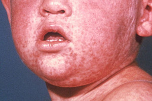 Boy with Measles