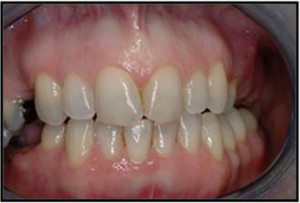 Pt-G-before-missing-multiple-teeth-dental-implant-candidate-gum ...