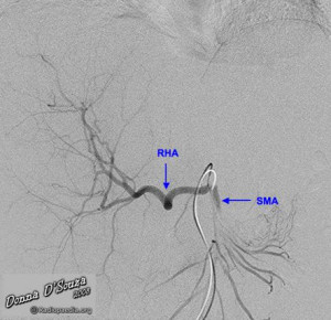 Search Results for: Replaced Right Hepatic Artery