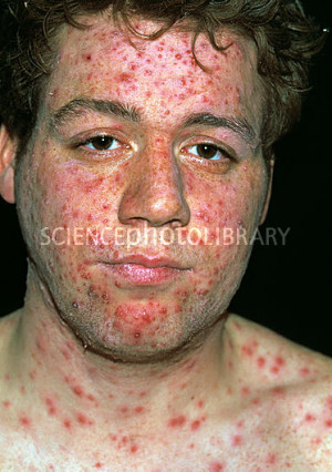 M130602-Chickenpox_blisters_on_face-SPL.jpg