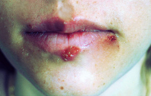 Related Pictures shingles symptoms contagious