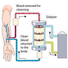 How will I feel during and after haemodialysis?