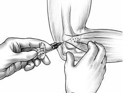 Lateral Epicondylitis Injection Procedure Note