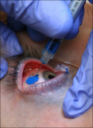 40 insertions of needle to turn the human eye into a blue one