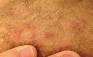Hair Bumps On Pubic Area