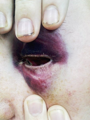 pain eye bruise velvet Black Eye bruised eye shiner