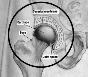 Osteoarthritis Of The Hip Exercises To Avoid