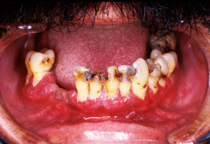 Gum Disease Tongue Problems...