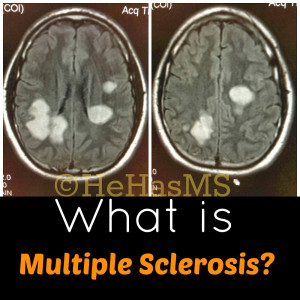 What is Multiple Sclerosis? The Answer to a Common Question...