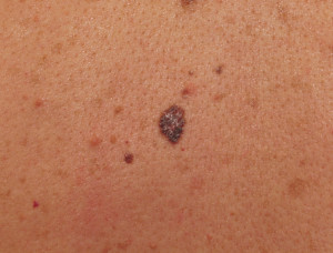 skin cancer pictures early stages on face