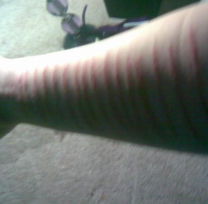 cuts on arms Image