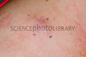 Melanoma Skin Cancer Spread