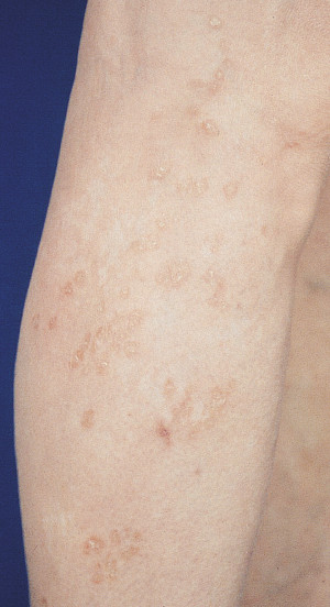 Sarcoid Skin Lesions Treatment