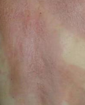 Related Pictures hiv rash