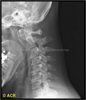 Rheumatoid Arthritis Cervical Spine X Ray
