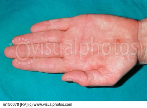 Mild Pompholyx Eczema