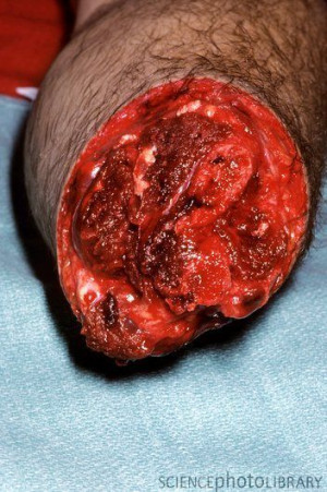 amputated arm, close-up. This man's left forearm was amputated ...